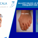 Alluce valgo le domande più frequenti dei pazienti