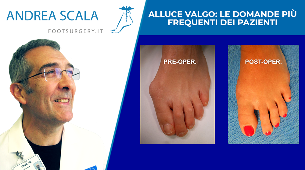 Alluce valgo le domande più frequenti dei pazienti