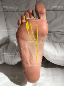 Metatarsalgia causata da Neuroma di Morton