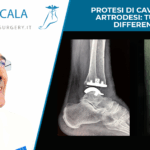 Protesi di caviglia vs artrodesi tutte le differenze