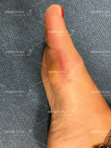 La foto mostra una grave infiammazione: la metatarsalgia