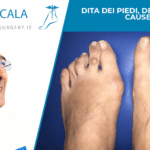 Dita dei piedi, deformità e cause -