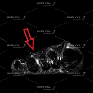 Risonanza magnetica . la freccia indica il punto in cui si trova il Neuroma di Morton