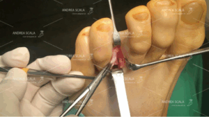 Fase della seduta operatoria per eliminazione del Neuroma di Morton