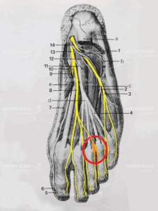 neuroma-di-morton-2.jpeg