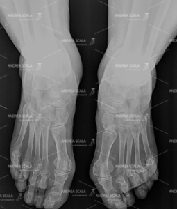 Rx- grafia  eseguita in carico