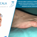 5° DITO DEL PIEDE “A MARTELLO”