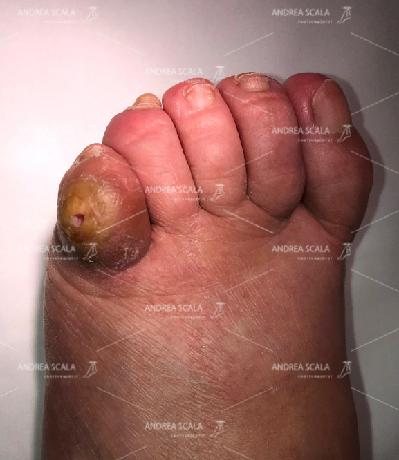 Il taglio del callo ha portato alla perforazione cutanea.