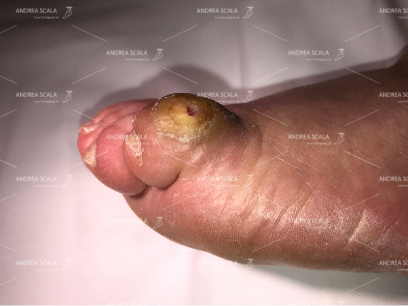 La foto mostra la perforazione cutanea. Quando le difese del corpo sono intaccate i germi e batteri penetrano all’interno dell’organismo umano.