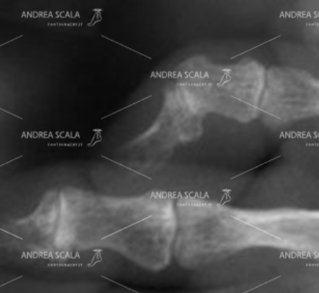 La RXgrafia mostra la patologia flessione delle falangi che non sono allineate con il metatarso.