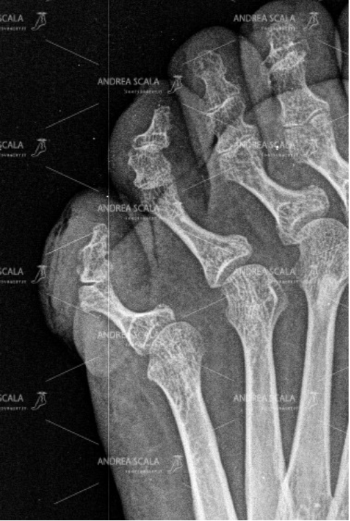 La RXgrafia è stata fatta troppo tardi. Si dimostra la deformità del 5° dito e si capisce il motivo della callosità che non guarisce.