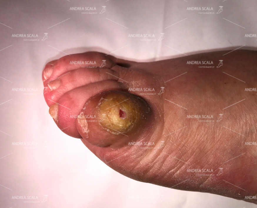 Si vede il foro sul 5° dito. I germi ed i batteri trovano la porta aperta per entrare nel corpo della paziente.