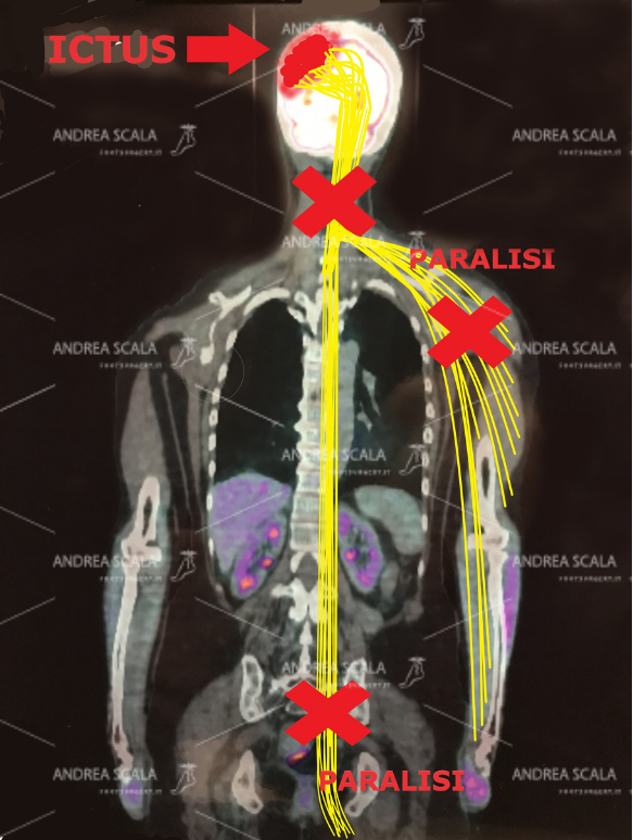 Lo schema mostra in modo elementare l’ictus che porta alla morte le cellule cerebrali. Dopo l’emorragia (oppure l’ischemia) non avviene il passaggio degli impulsi elettrici dall’altra parte del cervello. A causa dell’ictus la parte opposta del corpo rimane paralizzata. Si verifica l’emiplegia. La “rigenerazione” non è scientificamente possibile.