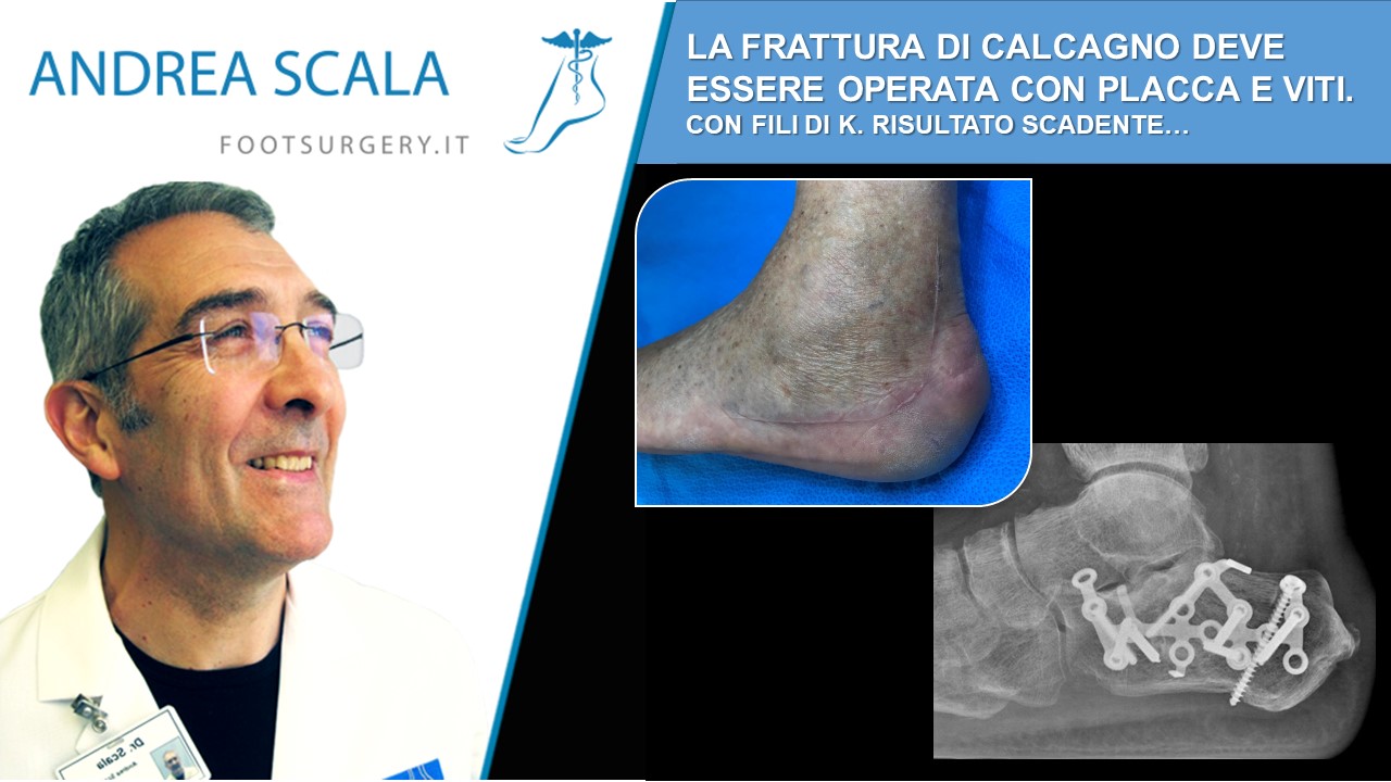 LA FRATTURA DI CALCAGNO DEVE ESSERE OPERATA CON PLACCA E VITI. CON I FILI DI K. RISULTATO E’ SCADENTE.