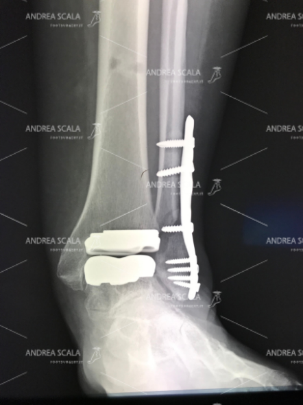 La RXgrafia anteriore fa vedere che la ricostruzione del perone con placca e viti alle volte non guarisce e può risultare instabile.  Il paziente già si sottopone ad un intervento tanto impegnativo quale la protesi di caviglia, non andrebbe sottoposto ad interventi supplementari che presentano a loro volta elementi di rischio.