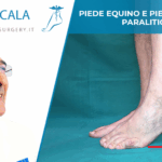 PIEDE EQUINO E PIEDE CADENTE PARALITICO.