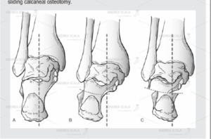 Lo schema illustra la osteotomia di calcagno negli adolescenti. Il piede pronato valgo giovanile viene corretto senza toccare le articolazioni.