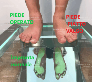 La foto mostra che il piede operato in età giovanile torna alla normalità. Infatti l’impronta del piede operato è normale, mentre l’impronta del piede pronato valgo è patologica. Il piede pronato valgo giovanile viene corretto senza toccare le articolazioni.