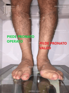 La foto mostra la visione anteriore di un paziente che è stato operato in età adulta. Si vede il confronto tra il piede pronato grave e il piede operato. E’ stato corretto anche l’alluce valgo.