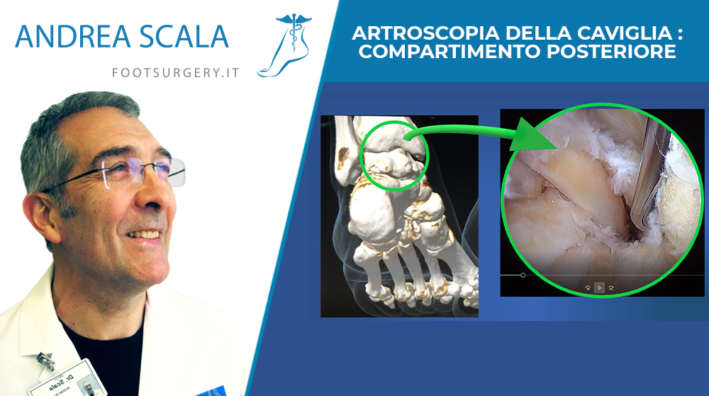 TENDINITE FLESSORE LUNGO DELL’ALLUCE