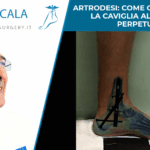 ARTRODESI COME CONDANNARE LA CAVIGLIA AL BLOCCO PERPETUO