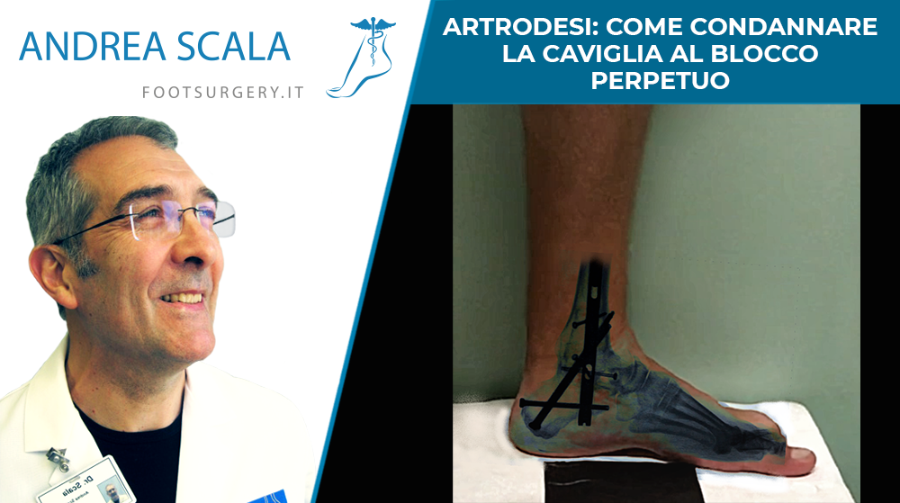 ARTRODESI COME CONDANNARE LA CAVIGLIA AL BLOCCO PERPETUO