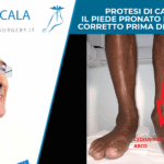 PROTESI DI CAVIGLIA. IL PIEDE PRONATO DEVE ESSERE CORRETTO PRIMA DELLA PROTESI.