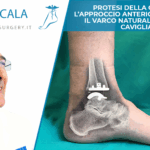 PROTESI DELLA CAVIGLIA. L’APPROCCIO ANTERIORE CONSENTE IL VARCO NATURALE VERSO LA CAVIGLIA.