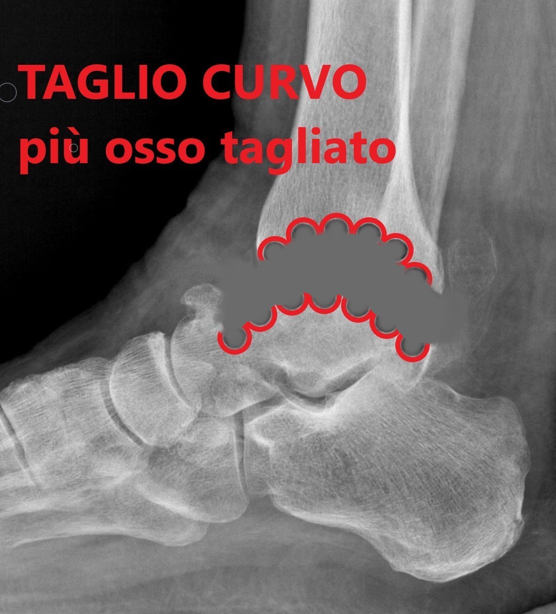 LA VIA D’ACCESSO LATERALE PREVEDE UNA FASE DI FRESATURA CHE COLLEGA  TUTTE LE PERFORAZIONI EFFETTUATE.  LO SCHEMA MOSTRA LA QUANTITÀ DI OSSO CHE VIENE SUCCESSIVAMENTE ASPORTATO.