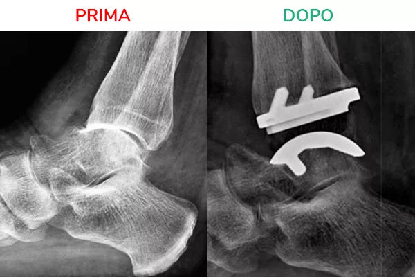 xprotesi-caviglia-01.jpg.pagespeed.ic.ZX2esYO5HW